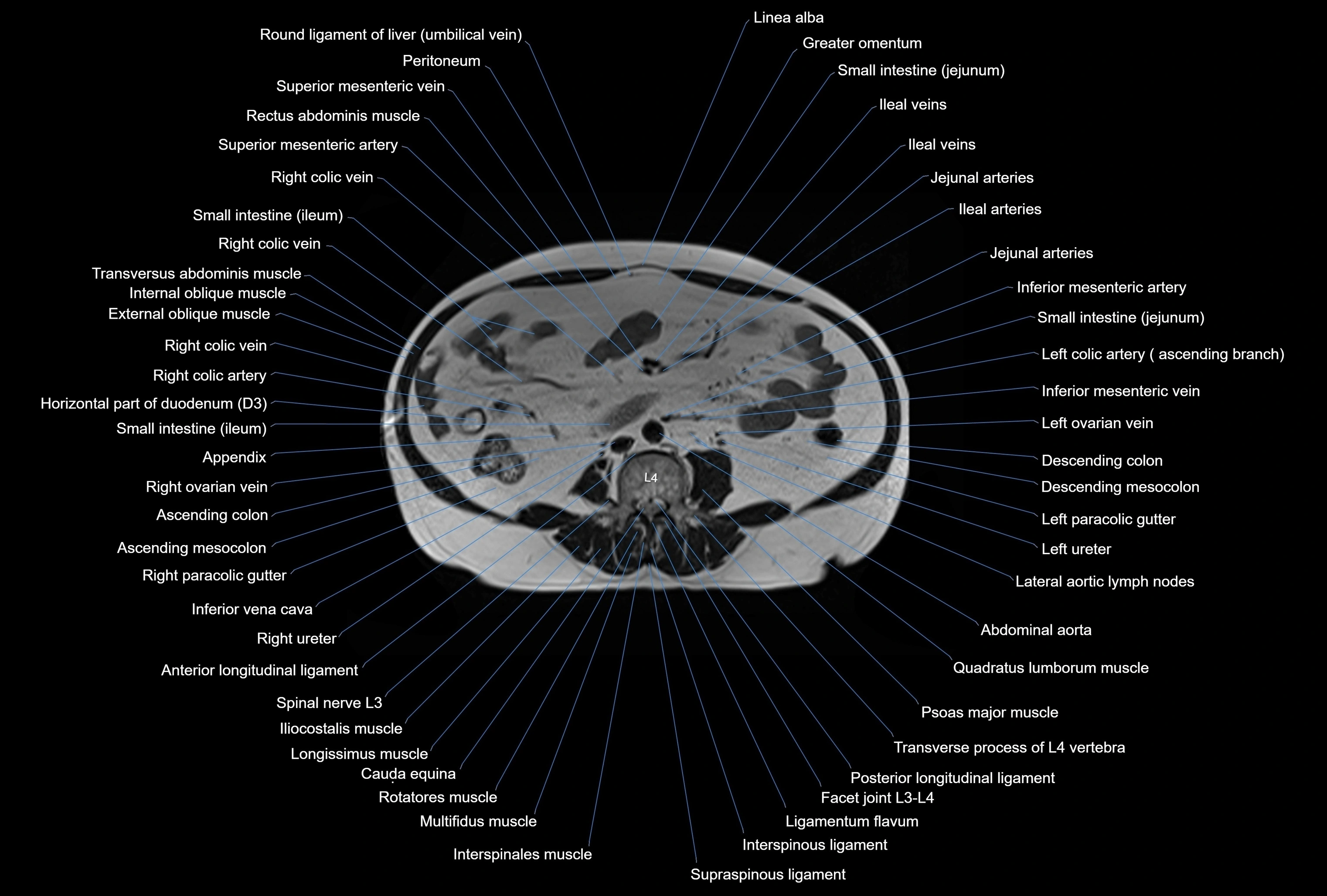 MRI Abdomen axial cross sectional anatomy radiology  image-img-00001-00030.webp